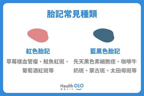 手背上有胎記|胎記怎麼產生、何時消除？醫師剖析胎記種類、胎記寓意